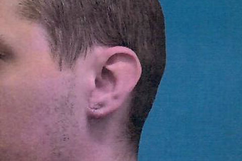 Gauged earlobe repair after